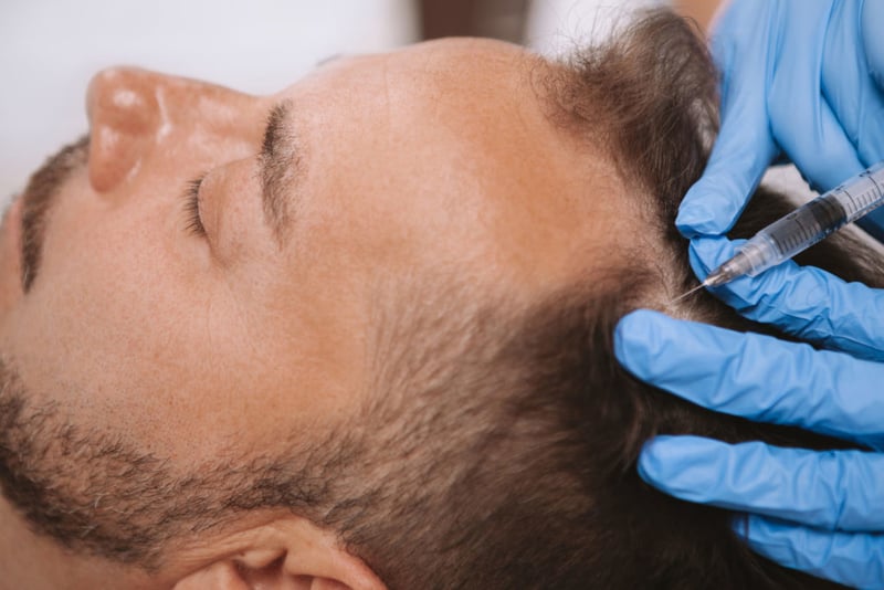 PRT therapy for hair loss in New Jersey